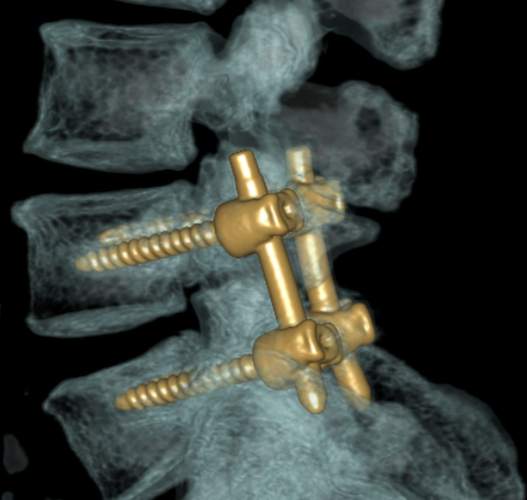 L4/5 pedicle screw instrumented fusion